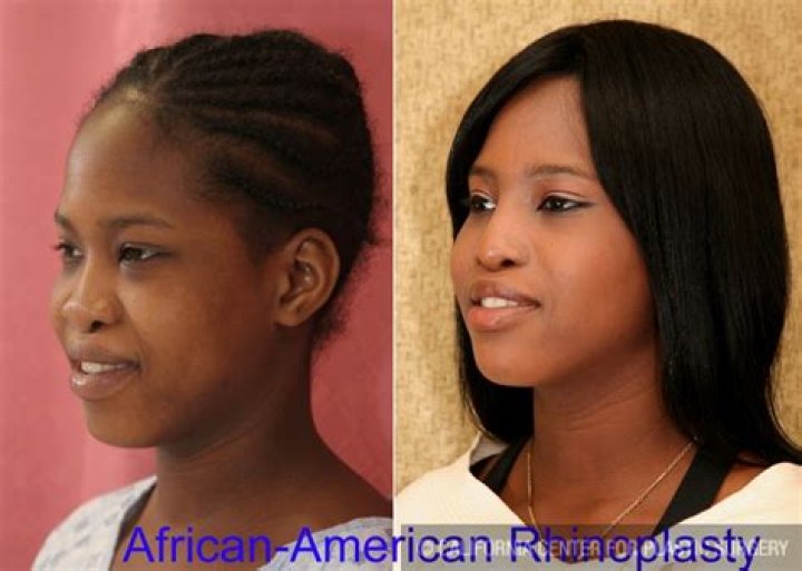African American Plastic Surgery Before And After