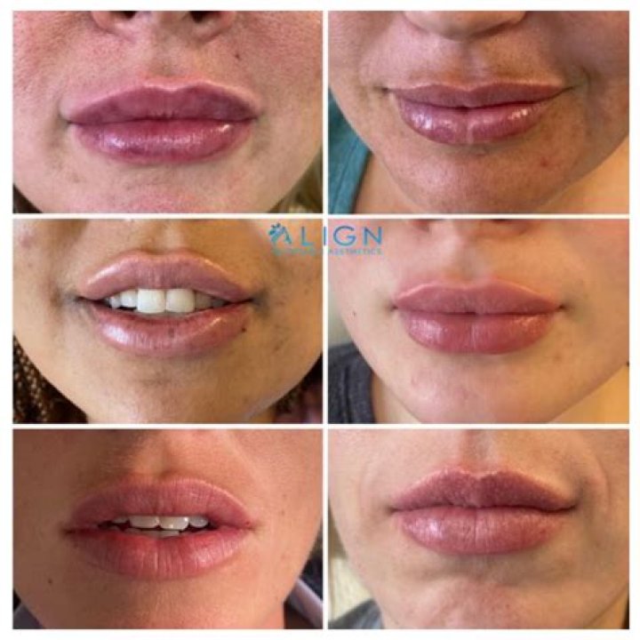 Can Lip Injections Make Your Lips Dry as a Side Effect? Allure