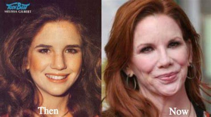Celebrity Melissa Gilbert Plastic Surgery Nose Jobe Before After http