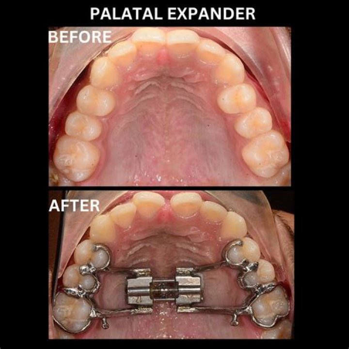 Pin on Expanders